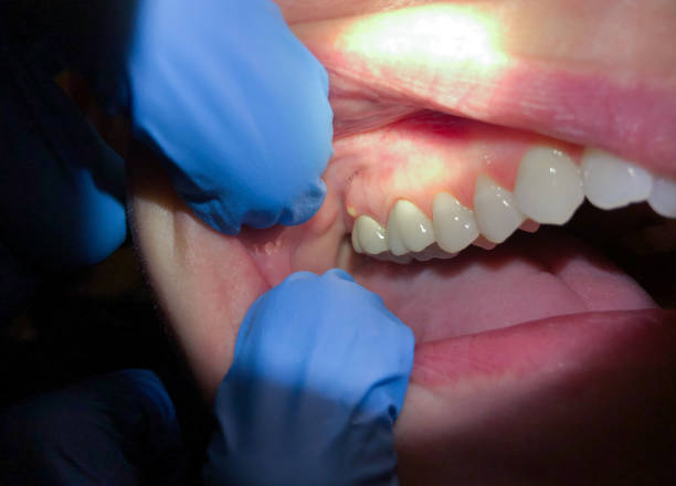 Best Urgent Dental Care for Toothaches in Lindstrom, MN